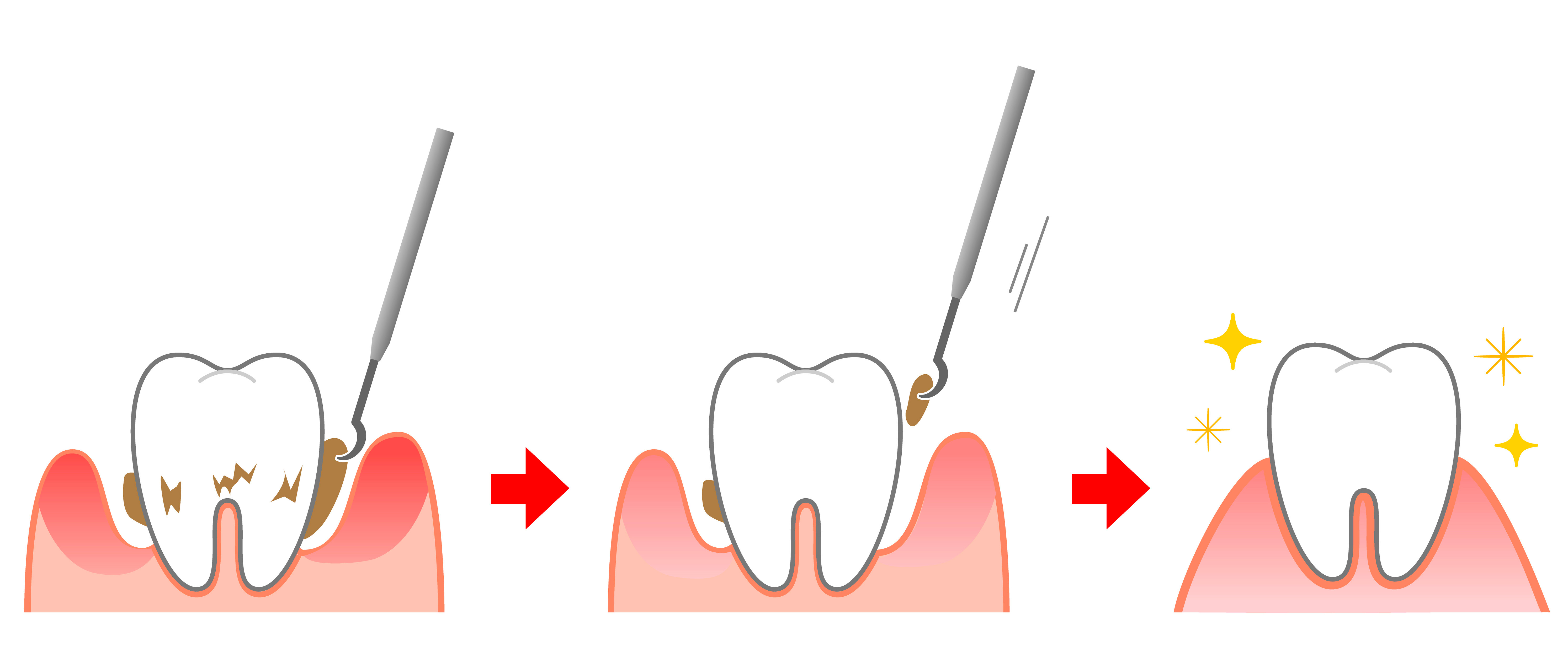 Illustration zeigt blutende Zahnbürste mit Zahnpasta als Warnzeichen für Parodontose und wichtige Parodontose Prophylaxe in Lüdenscheid